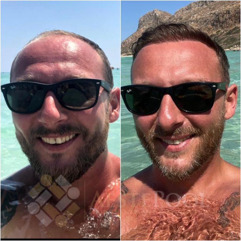 Metamorfoza przeszczepu włosów - Daniel Metamorfoza przeszczepu włosów - Daniel