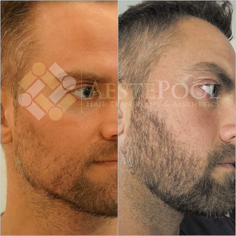 Metamorfoza przeszczepu włosów - Jakub M. Metamorfoza przeszczepu włosów - Jakub M.