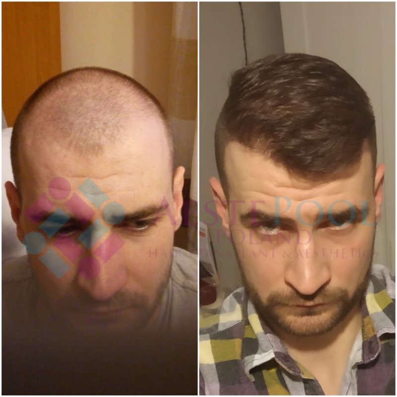 Metamorfoza przeszczepu włosów - Michał W. Metamorfoza przeszczepu włosów - Michał W
