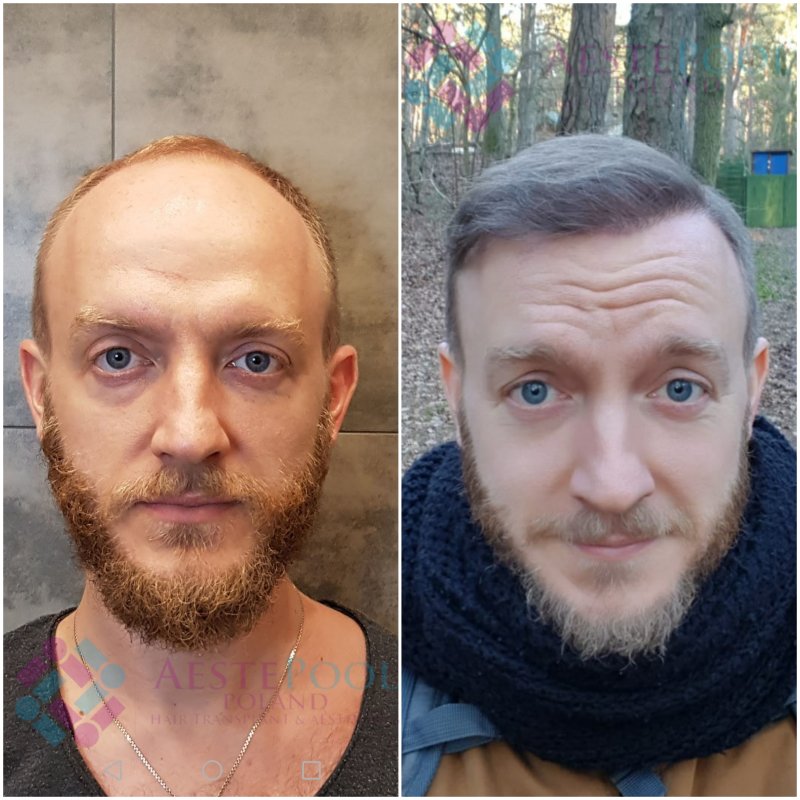 Metamorfoza przeszczepu włosów - Adrian Metamorfoza przeszczepu włosów - Adrian