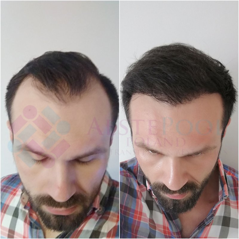 Metamorfoza przeszczepu włosów - Damian Metamorfoza przeszczepu włosów - Damian