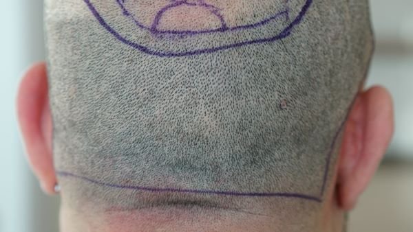 MICRO FUE - Mechaniczny przeszczep włosów