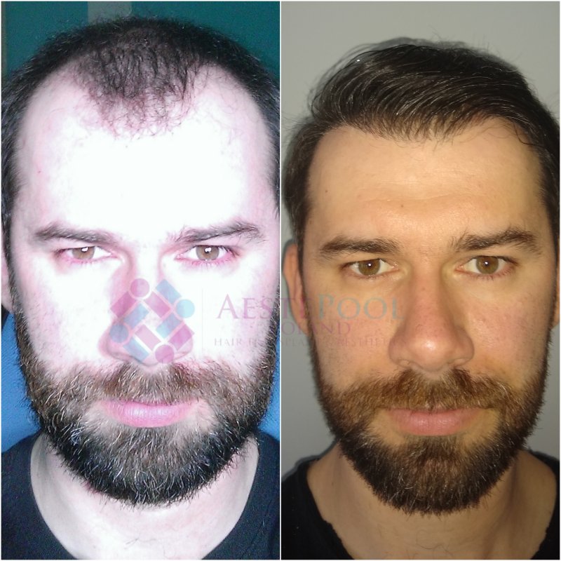 Metamorfoza przeszczepu włosów Metamorfoza przeszczepu włosów