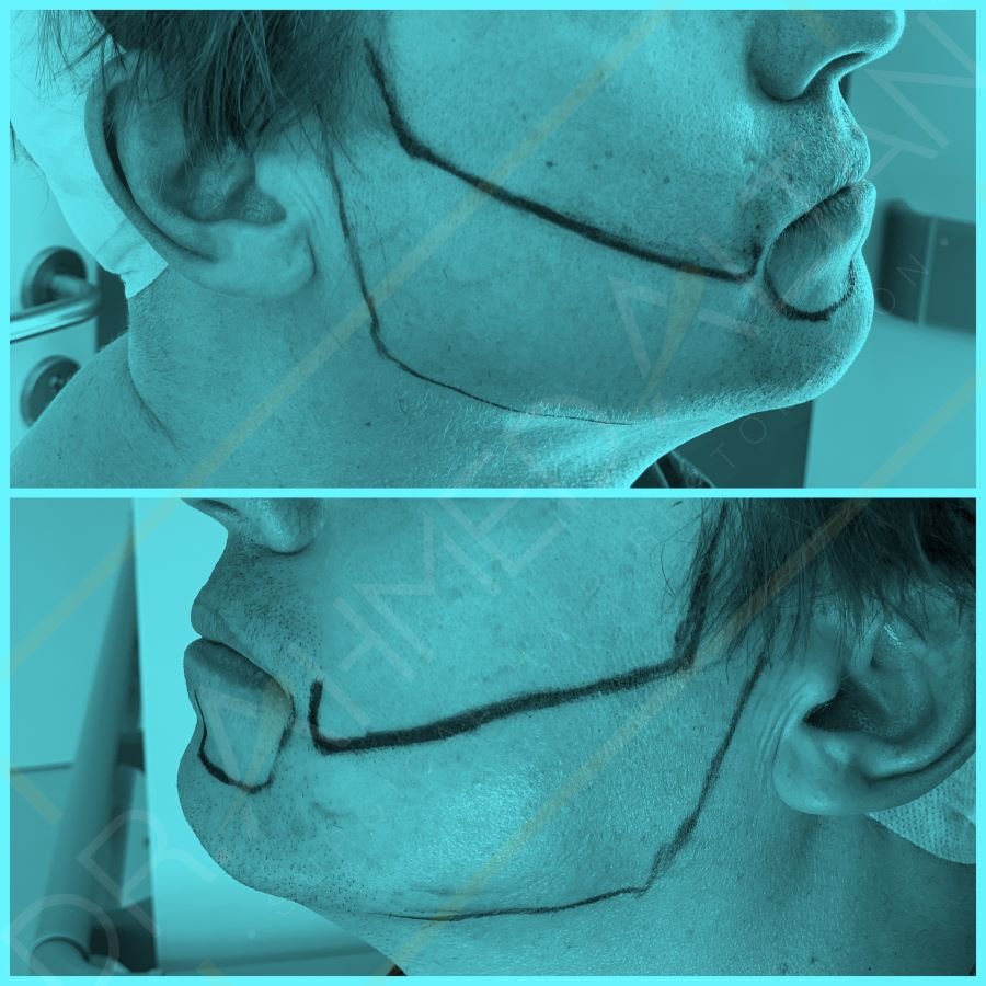 Przeszczep włosów brody