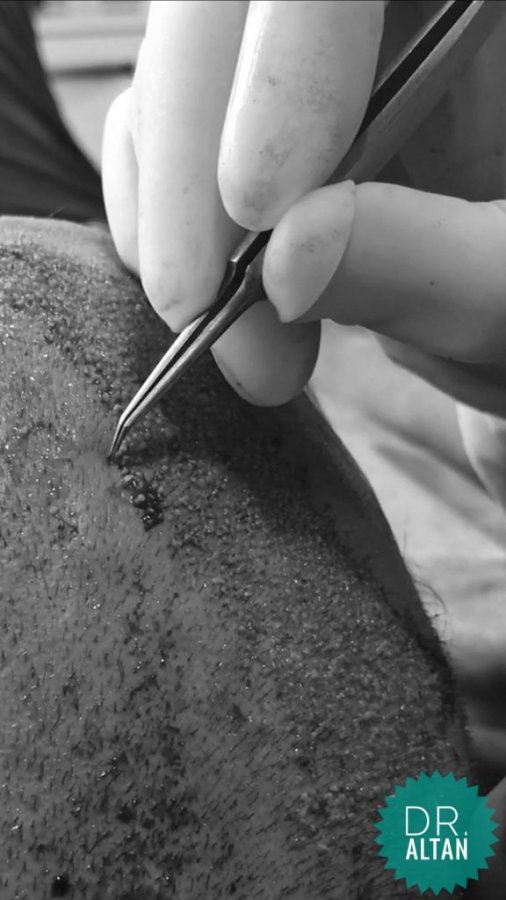 Wypadające włosy - szczotka