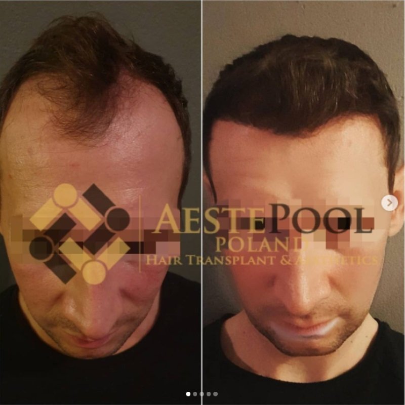 Metamorfoza przeszczepu włosów - Łukasz Metamorfoza przeszczepu włosów - Łukasz